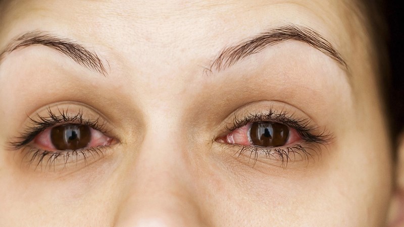 Triệu chứng đỏ mắt cho thấy cơn sốt đang rất cao