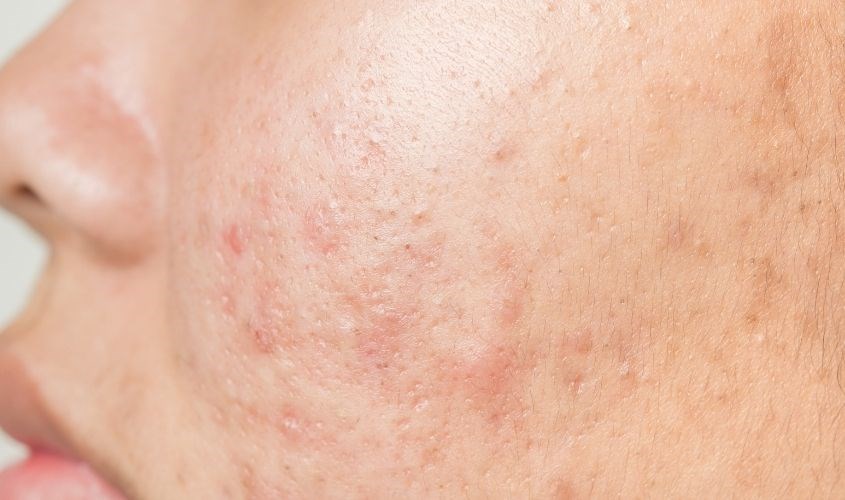 Bột nghệ làm mờ vết thâm, sáng da