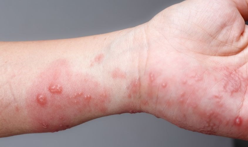 Bột nghệ còn có thể trị bệnh ghẻ