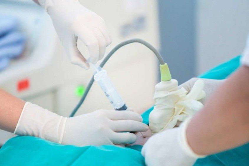 Sinh thiết gai nhau được thực hiện ở tuần thứ 10 đến tuần thứ 12 của thai kỳ Sinh thiết gai nhau được thực hiện ở tuần thứ 10 đến tuần thứ 12 của thai kỳ