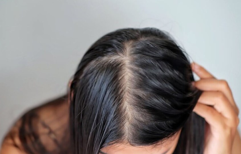 Nguyên nhân và cách trị tóc dầu bết dính hiệu quả