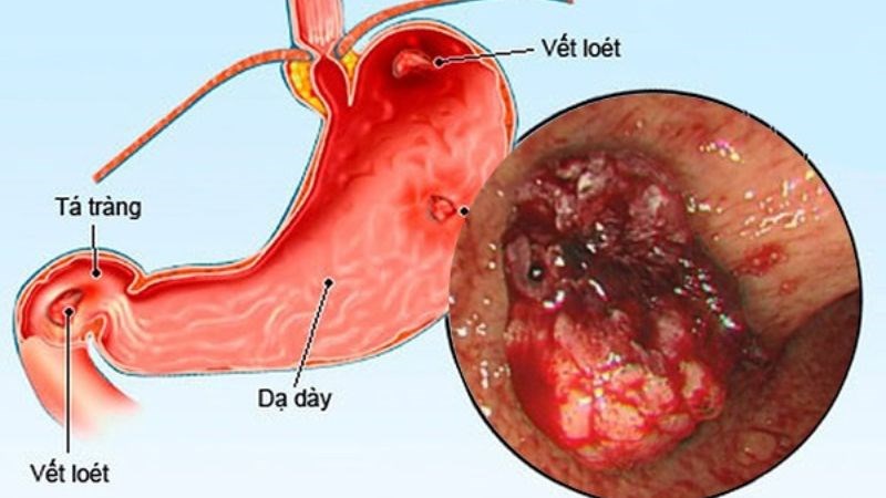 Viêm loét dạ dày