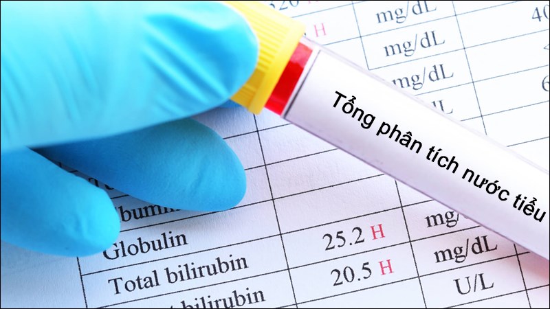 Một trong các xét nghiệm thường gặp là tổng phân tích nước tiểu