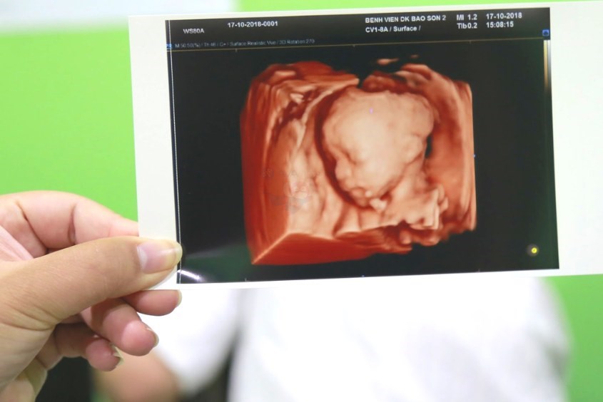 Kết quả siêu âm hình thái học sẽ bao gồm hình ảnh, các chỉ số sinh học liên quan tới sự phát triển của bé