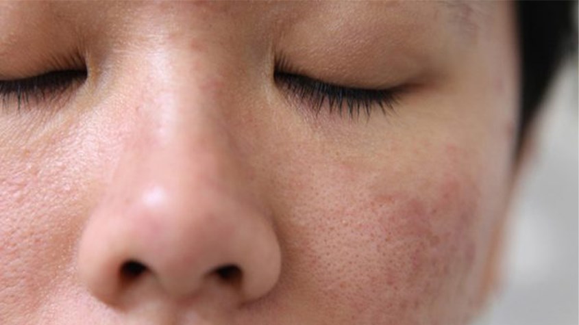 Ngăn ngừa tình trạng viêm nang lông