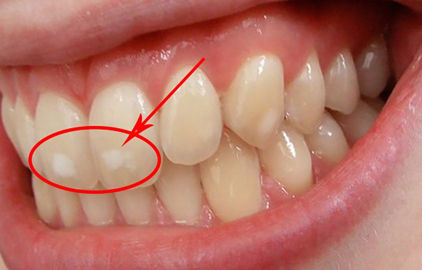 Nhiễm Fluor cũng có thể gây ảnh hưởng đến men răng