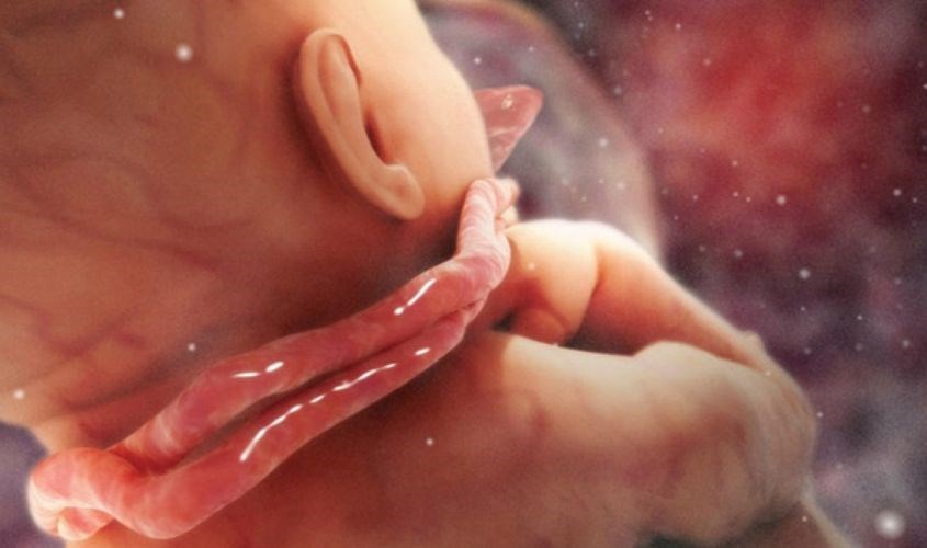 Dây rốn quấn cổ là gì?