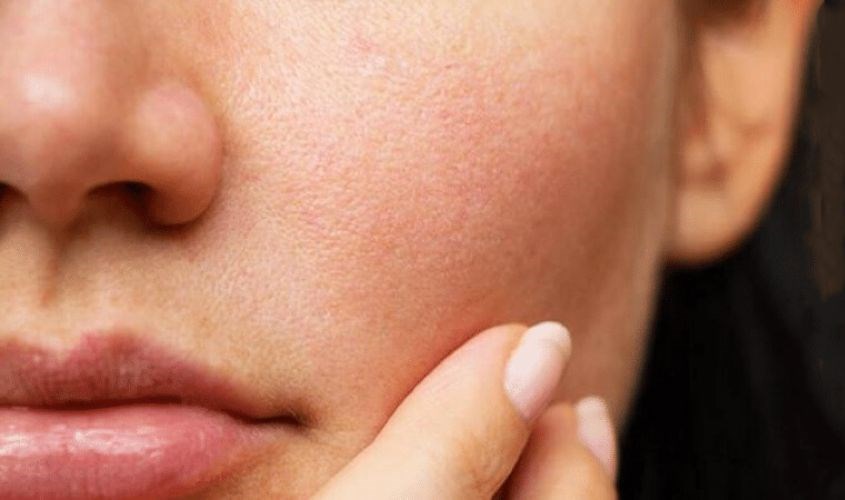 Toner Some By Mi có thể dùng được cho cả da nhạy cảm