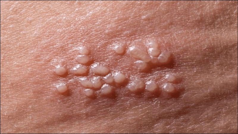 Mụn rộp sinh dục có thể xảy ra ở cả nam và nữ