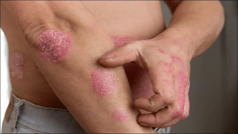 Bệnh vẩy nến là bệnh da liễu mãn tính phổ biến