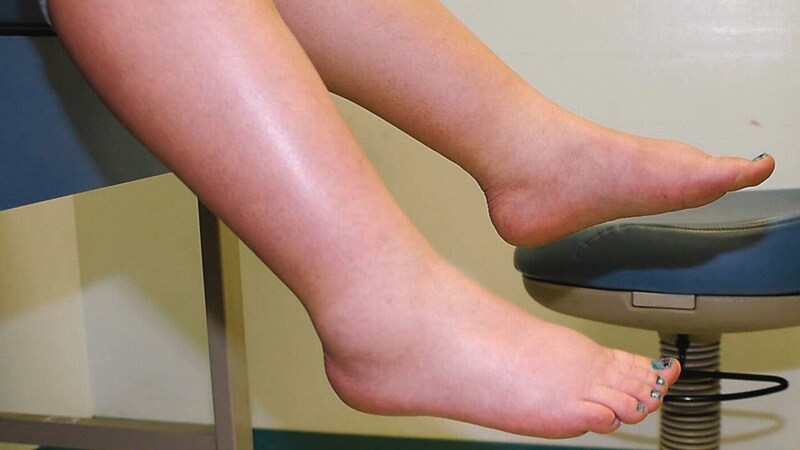 Cam thảo đất có thể gây ra hiện tượng giữ nước và tích trữ natri
