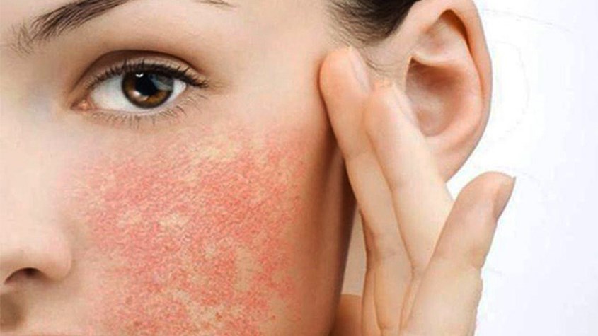 Dị ứng với chất kích ứng