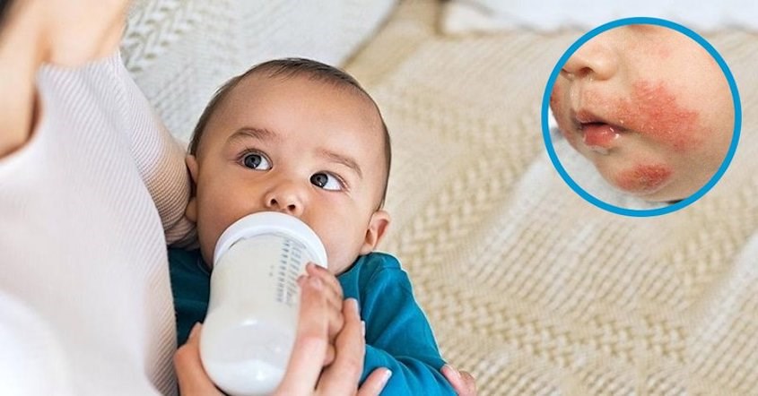 Trẻ dị ứng sữa bò là tình trạng dị ứng khi sử dụng sữa bò và các chế phẩm từ sữa