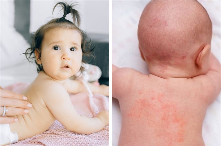 Dấu hiệu nhận biết trẻ bị vảy nến Trẻ bị vảy nến
