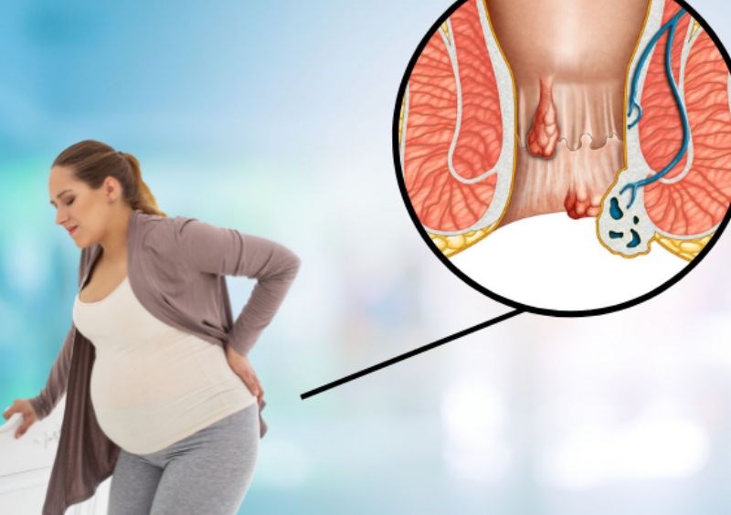 Nước ép hành lá thường được sử dụng để giảm bớt sự khó chịu của bệnh trĩ Nước ép hành lá thường được sử dụng để giảm bớt sự khó chịu của bệnh trĩ