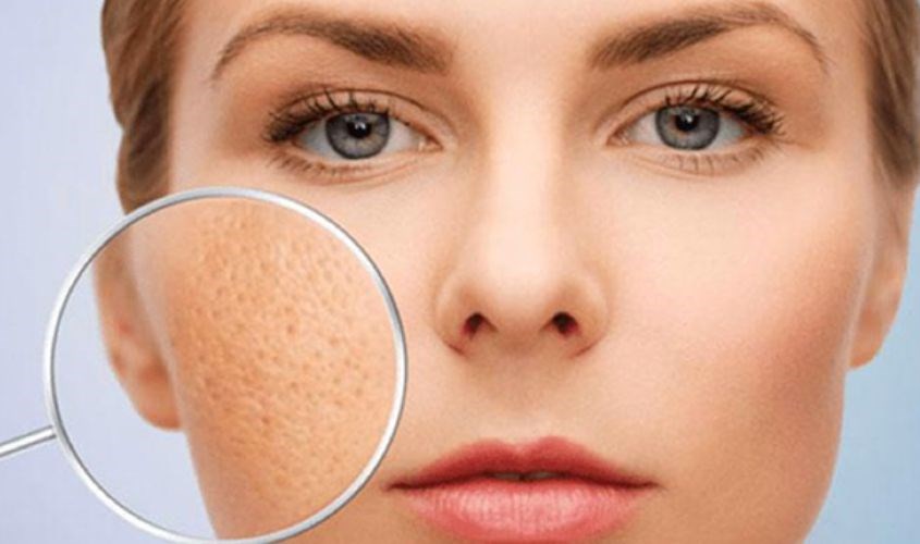 Se khít lỗ chân lông hiệu quả Se khít lỗ chân lông hiệu quả