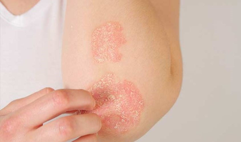 Biểu hiện của bệnh vảy nến là da bị đỏ, bung những lớp da trên bề mặt