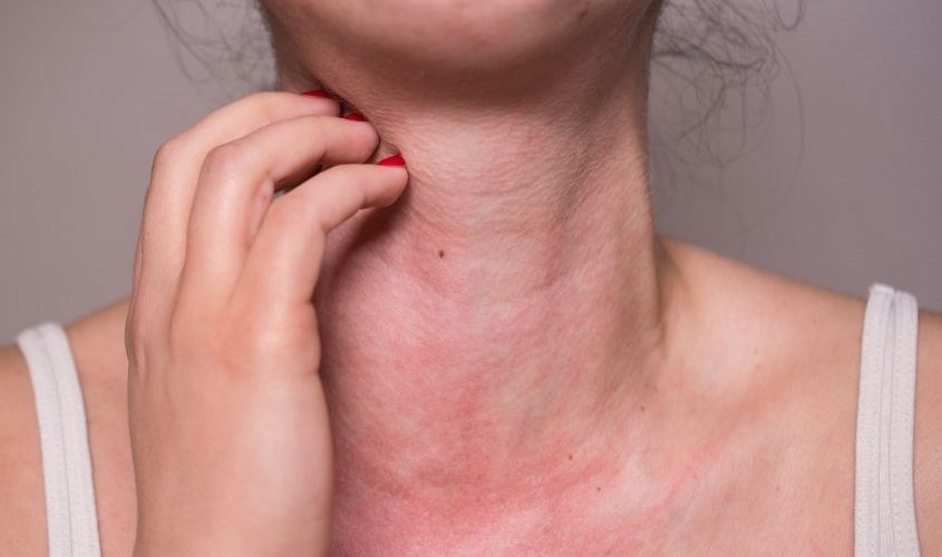 Không kiểm tra kem dưỡng trước khi dùng có thể gây kích ứng