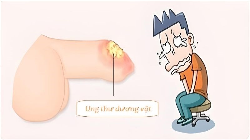 Tinh dịch có mùi hôi có thể là dấu hiệu của một số bệnh dễ gây ung thư dương vật