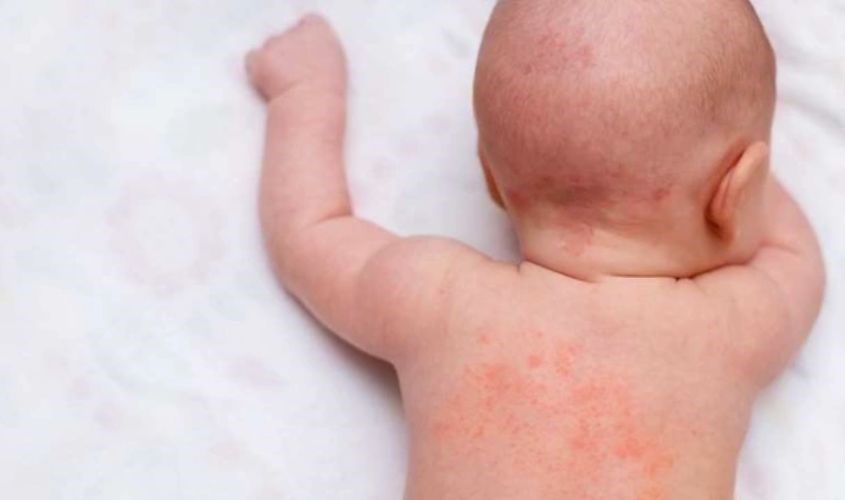 Các vết rôm sảy, mẫn ngứa hay những vùng da khô nứt nẻ được giảm rõ rệt sau 2 ngày sử dụng