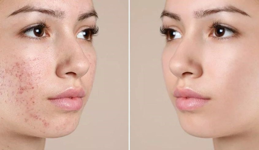 Không chỉ mụn đầu đen mà các loại mụn khác cũng sẽ thuyên giảm