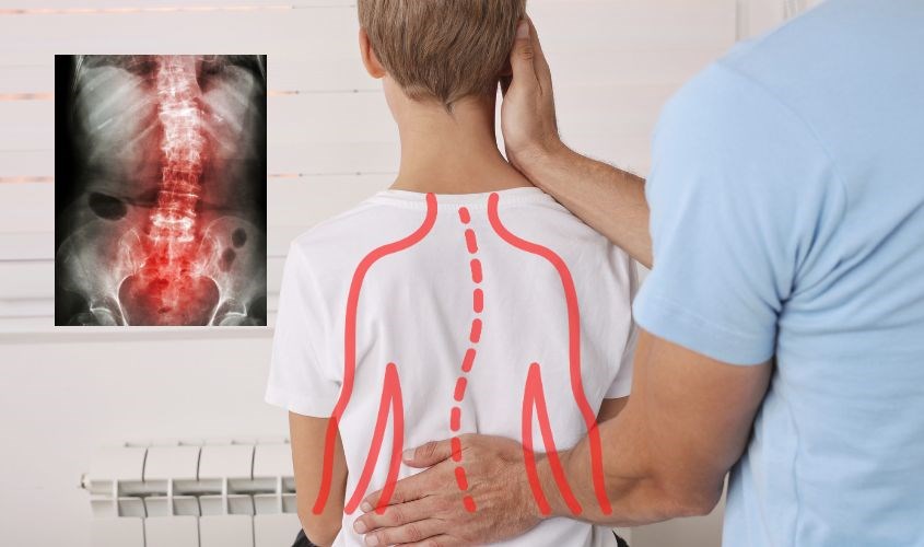 Thiếu vitamin D có thể gây vẹo cột sống