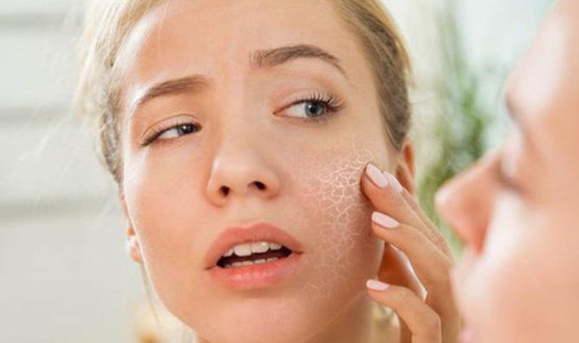 Da mất đi độ ẩm tự nhiên