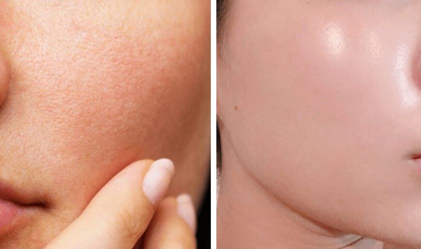 Việc dùng cây lăn lạnh thường xuyên cũng sẽ giúp cho da săn chắc hơn