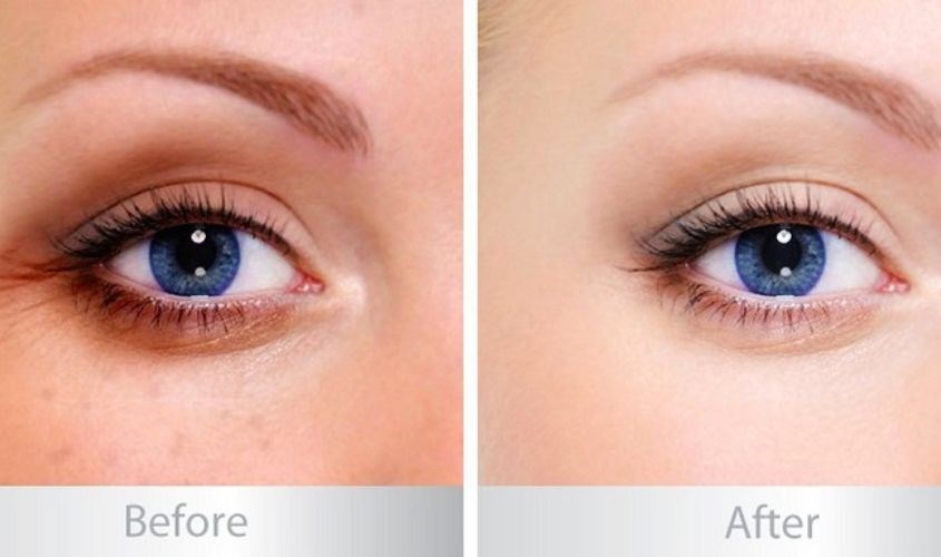 Chị em phụ nữ thường gặp phải quầng thâm và bọng mắt