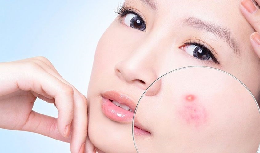 Bạn nên dùng cây lăn lạnh để massage nhẹ lên vùng bị sưng như má, mắt và sưng mụn