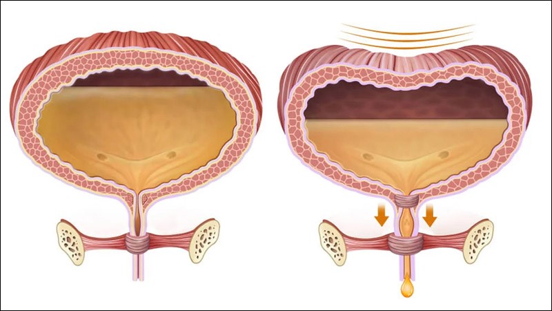 Mất cảm giác bàng quang đầy nước tiểu cũng là triệu chứng của bàng quang thần kinh Mất cảm giác bàng quang đầy nước tiểu cũng là triệu chứng của bàng quang thần kinh