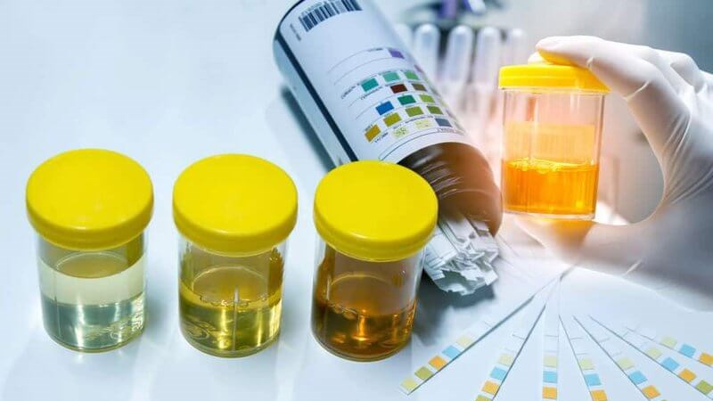 Xét nghiệm nước tiểu giúp chẩn đoán bàng quang thần kinh Xét nghiệm nước tiểu giúp chẩn đoán bàng quang thần kinh