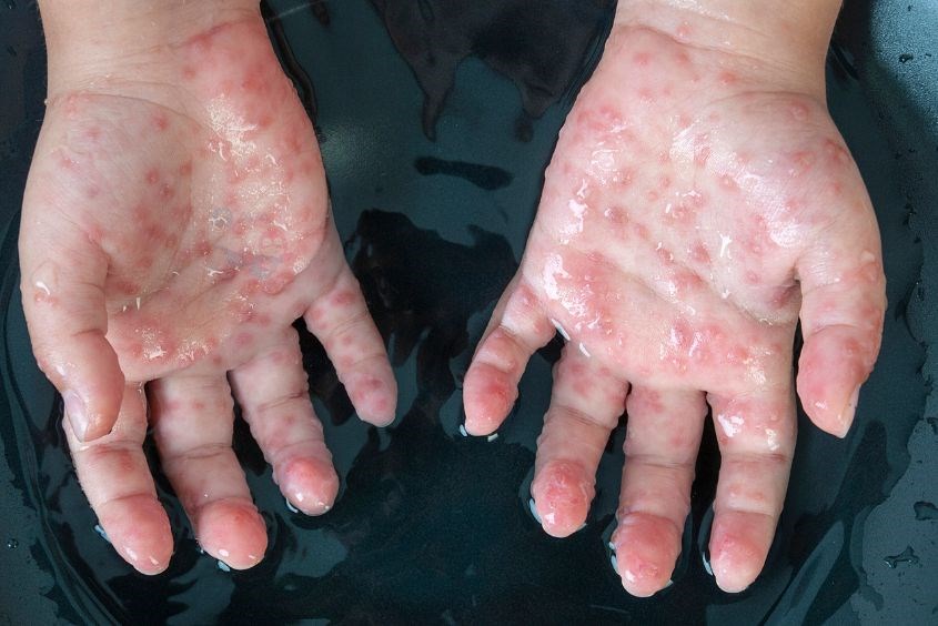 Phòng khám nhi Bến Tre - nhi đồng thành phố hỗ trợ điều trị các bệnh thường gặp ở trẻ