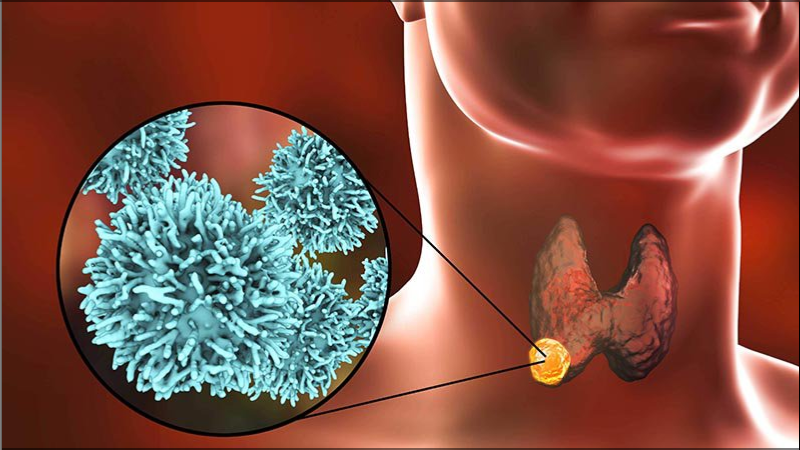 Ung thư tuyến giáp là tình trạng các tế bào ung thư hình thành trong các mô của tuyến giáp