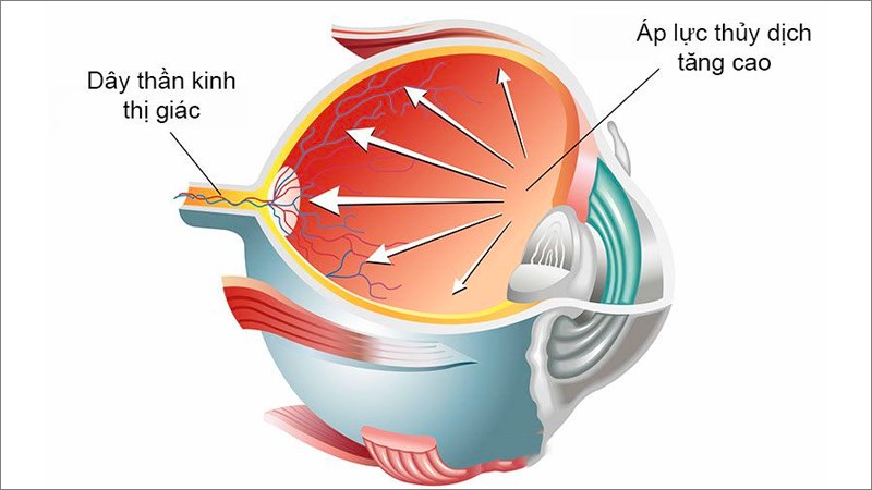 Tích tụ thủy dịch gây tăng áp lực lên nhãn cầu