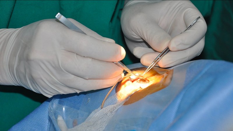 Bạn có thể bị tăng nhãn áp sau phẫu thuật giác mạc