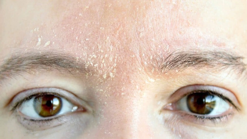 Lựa chọn kem chống nắng không phù hợp sẽ khiến da khô