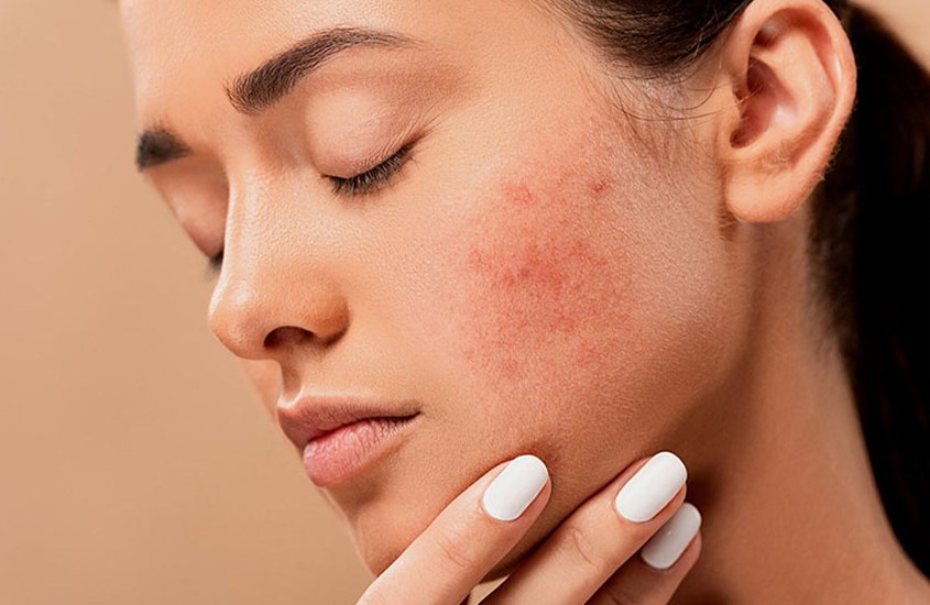 Hạn chế tối đa việc nặn mụn vì điều này có thể dẫn đến sẹo và nhiễm trùng da