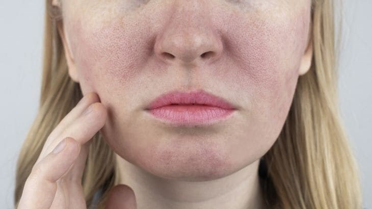 Người có làn da nhạy cảm xông hơi nhiều sẽ dễ bị mẩn đỏ