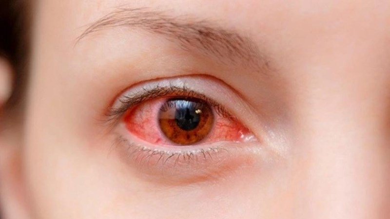 Làm thế nào để chẩn đoán bệnh đau mắt đỏ?

