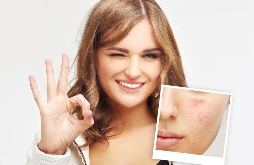 Cải thiện tình trạng mụn ở da rõ rệt