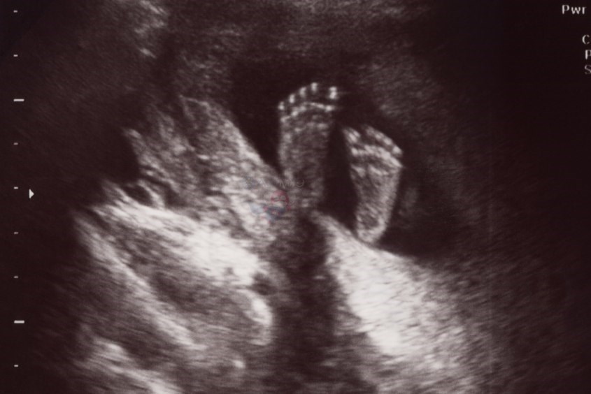 Tính tuổi thai sử dụng chiều dài bàn chân thai nhi sẽ chính xác hơn so với siêu âm