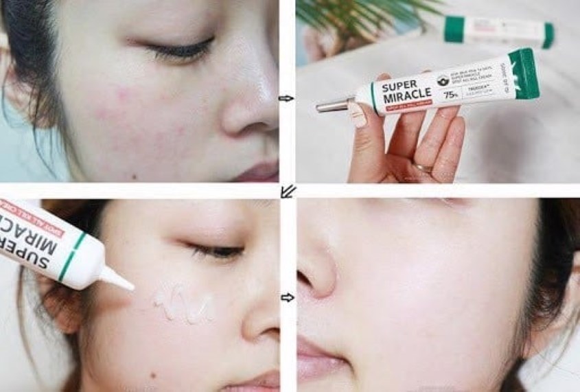 Tình trạng mụn sẽ thuyên giảm sau 14 ngày sử dụng