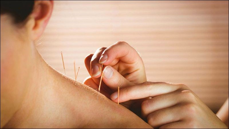 Châm cứu là một trong những phương pháp giúp thay đổi hoạt động của não và giảm co giật