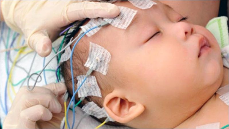 Đo điện não là xét nghiệm phổ biến trong chẩn đoán bệnh động kinh