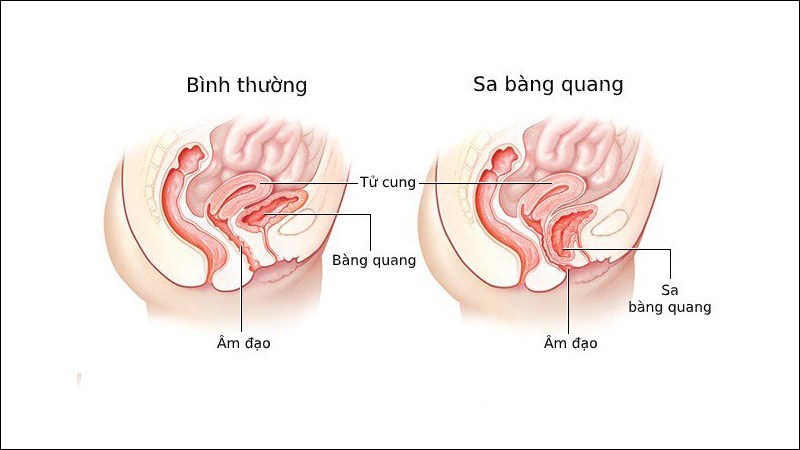 Thành bàng quang sa xuống âm đạo ảnh hưởng đến dòng chảy của nước tiểu