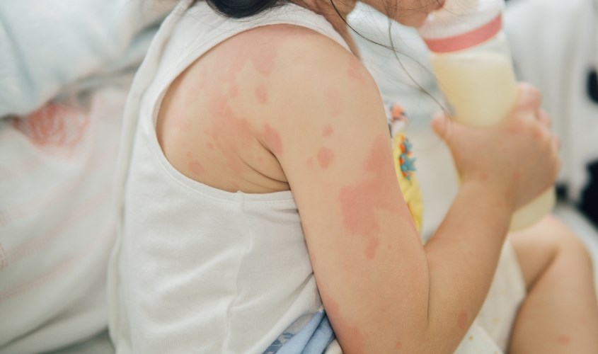 Nổi ban đỏ cũng là một trong những phản ứng của bé khi tiếp xúc với loại sữa mới
