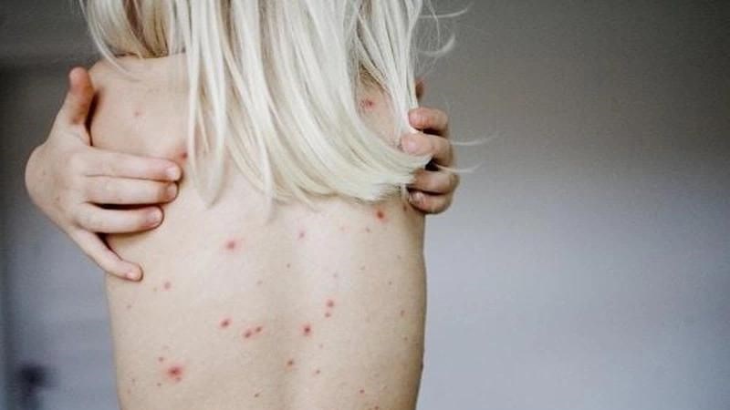 Có thể xuất hiện những vết loét trên da trong giai đoạn I