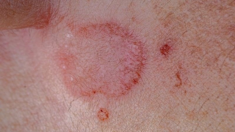 Đào ban là triệu chứng đặc trưng của giang mai giai đoạn 2