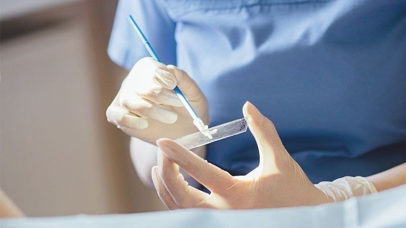 Soi tươi có thể giúp phát hiện giang mai